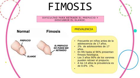 fimosis foto|Circuncisión fotos